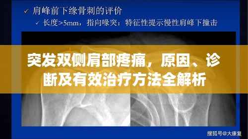 突发双侧肩部疼痛,原因、诊断及有效治疗方法全解析